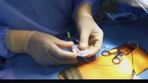 Implantation of Spinal Cord Stimulator by Joe Ordia, MD