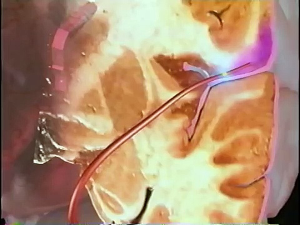 Knowing The Signs Of Having A Stroke / Educational Documentary Video