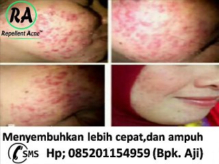 085201154959, Obat Jerawat Untuk Ibu Menyusui