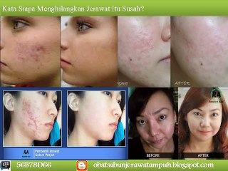 SMS 0858 7708 3892, Obat Penghilang Jerawat Kecil