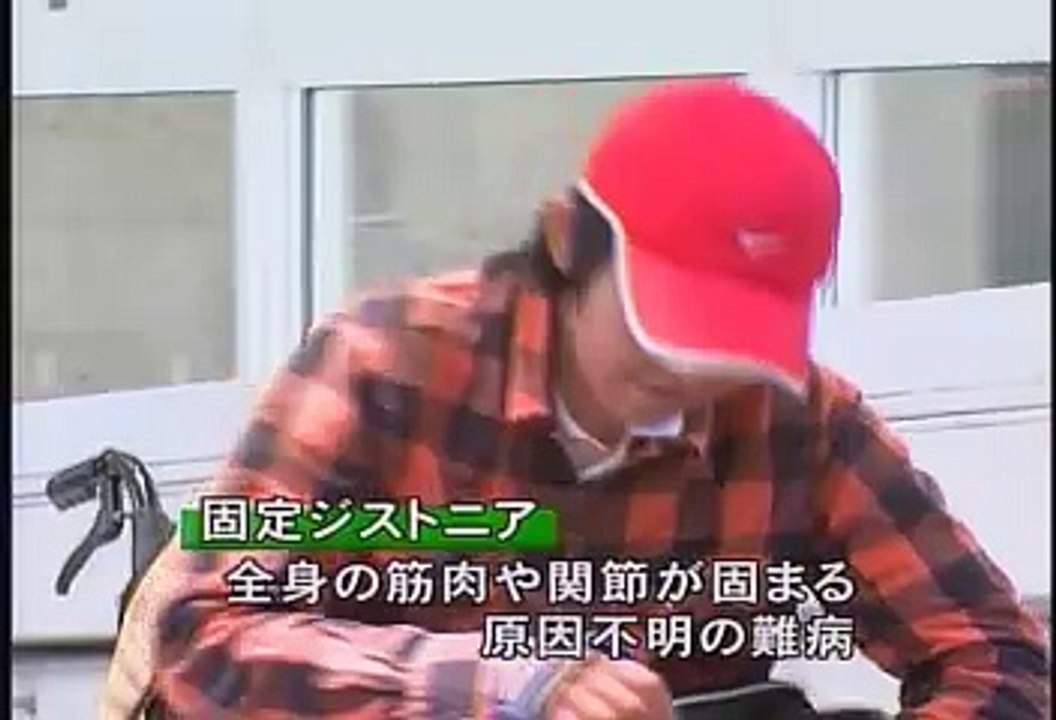 固定ジストニア