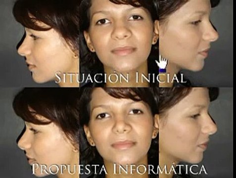 Rinomodelación - Nariz de base ancha (II) (sin rinoplastia)