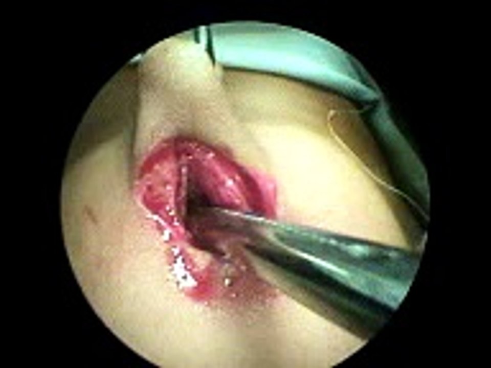 Laparoscopic Appendicectomy