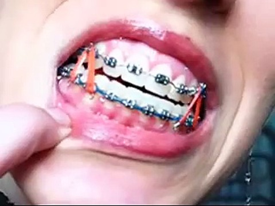 Inside my mouth
