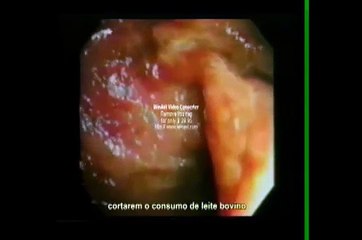 Cuide de Sua alimentação - Video do intestino