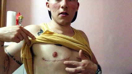 FTM Transition: 2 Months post-op