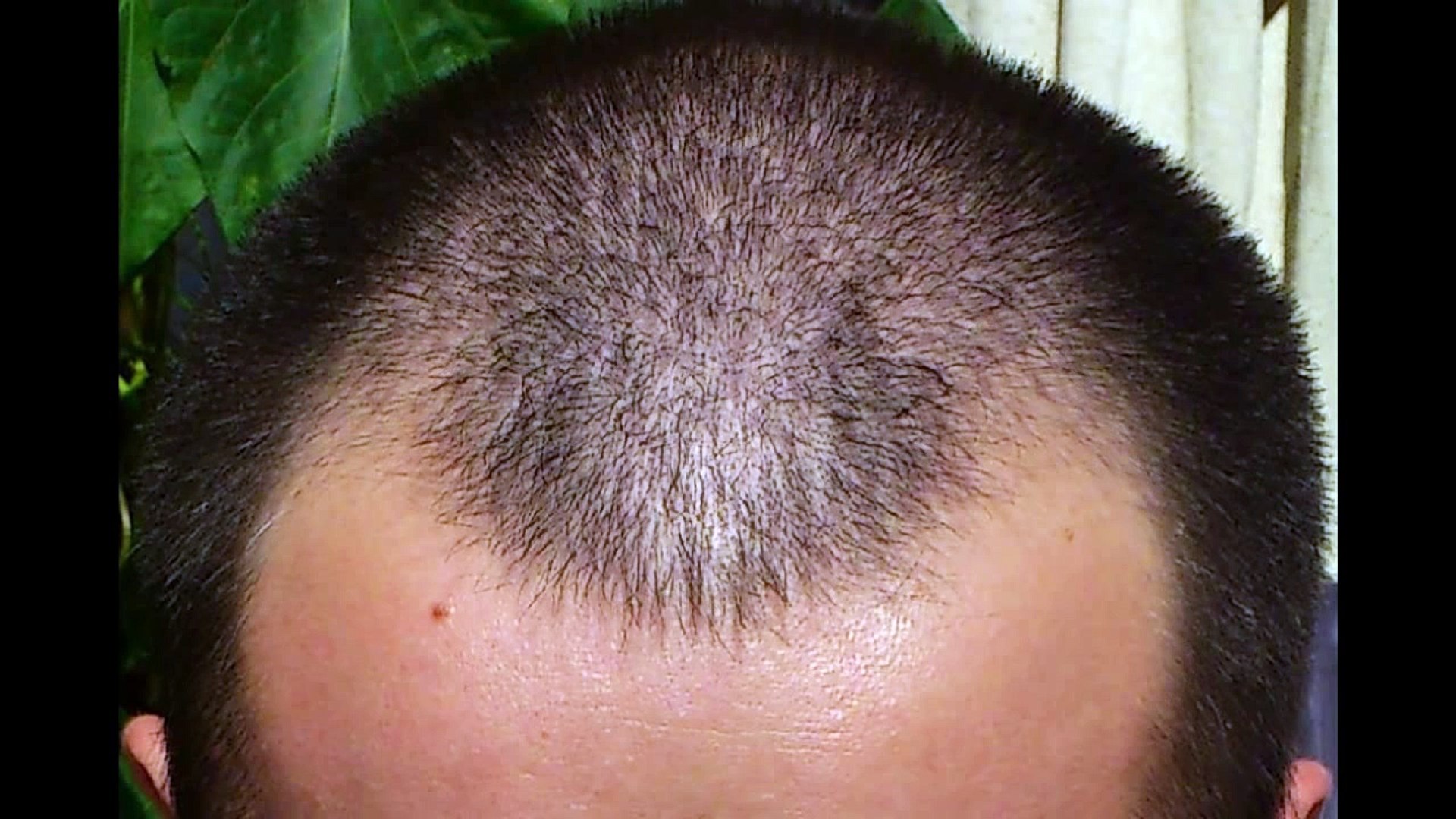 1 year minoxidil hair regrowth results, before and after. 2013! - video  Dailymotion