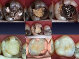 Uso Clinico de Materiales Dentales V2008