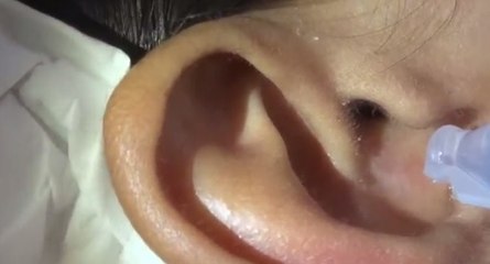 Il verse de l'eau dans son oreille ce qui va en sortir est répugnant