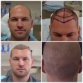 Hair Transplant in Los Angeles - FUE Hair Restoration and FUE Hair Transplant Clinic