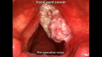Vocal cord cancer treatment - MGH Voice Center
