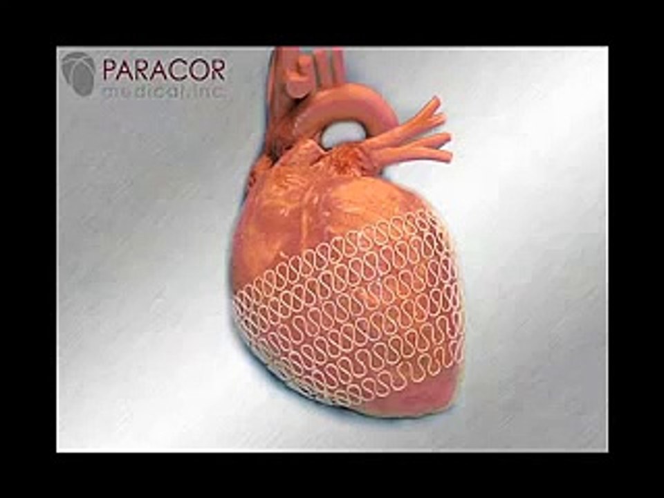 Enlarged Heart Animation