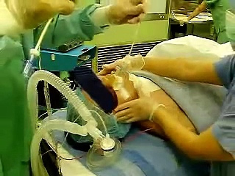 ﾁｭｰﾌﾞｴｸｽﾁｪﾝｼﾞｬｰ を留置したまま 抜管 tube exchanger