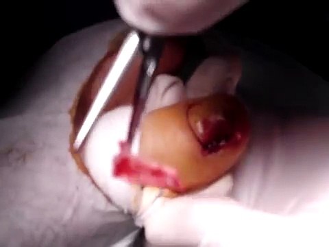 ingrown toenail Surgery (Onychocryptosis) - Wedge nail resection + matricectomy