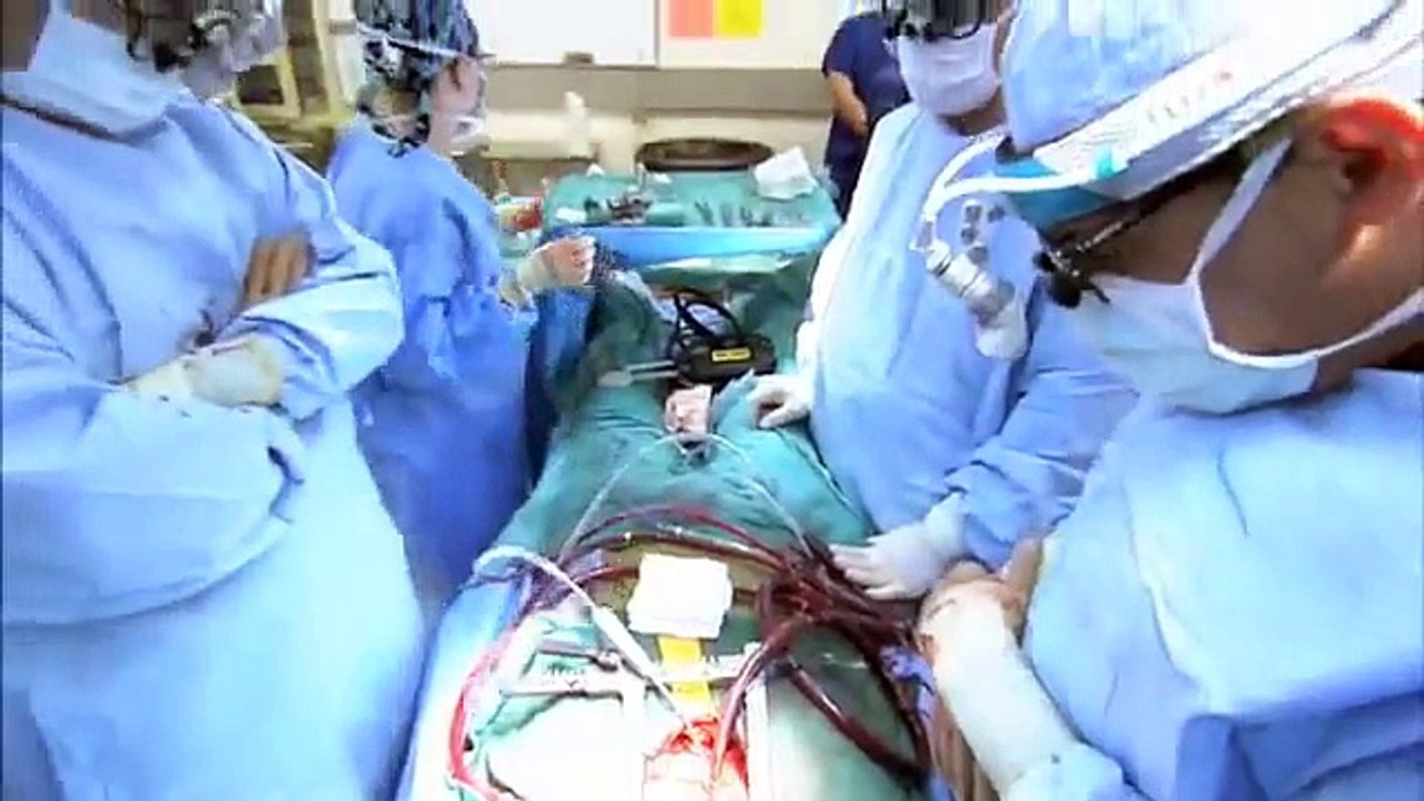 Heart Bypass Surgery Explained Part3