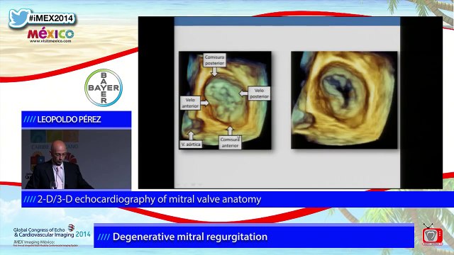 2-D/3-D echocardiography of mitral valve anatomy - L. Pérez (Eng)