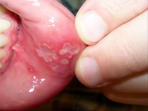 MOUTH ULCER , HEALTH EDUCATION , INFECTION CONTROL (ICSP) , URDU / HINDI