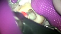 顕微鏡歯科　あずま歯科クリニック『痛い歯から膿を出す』