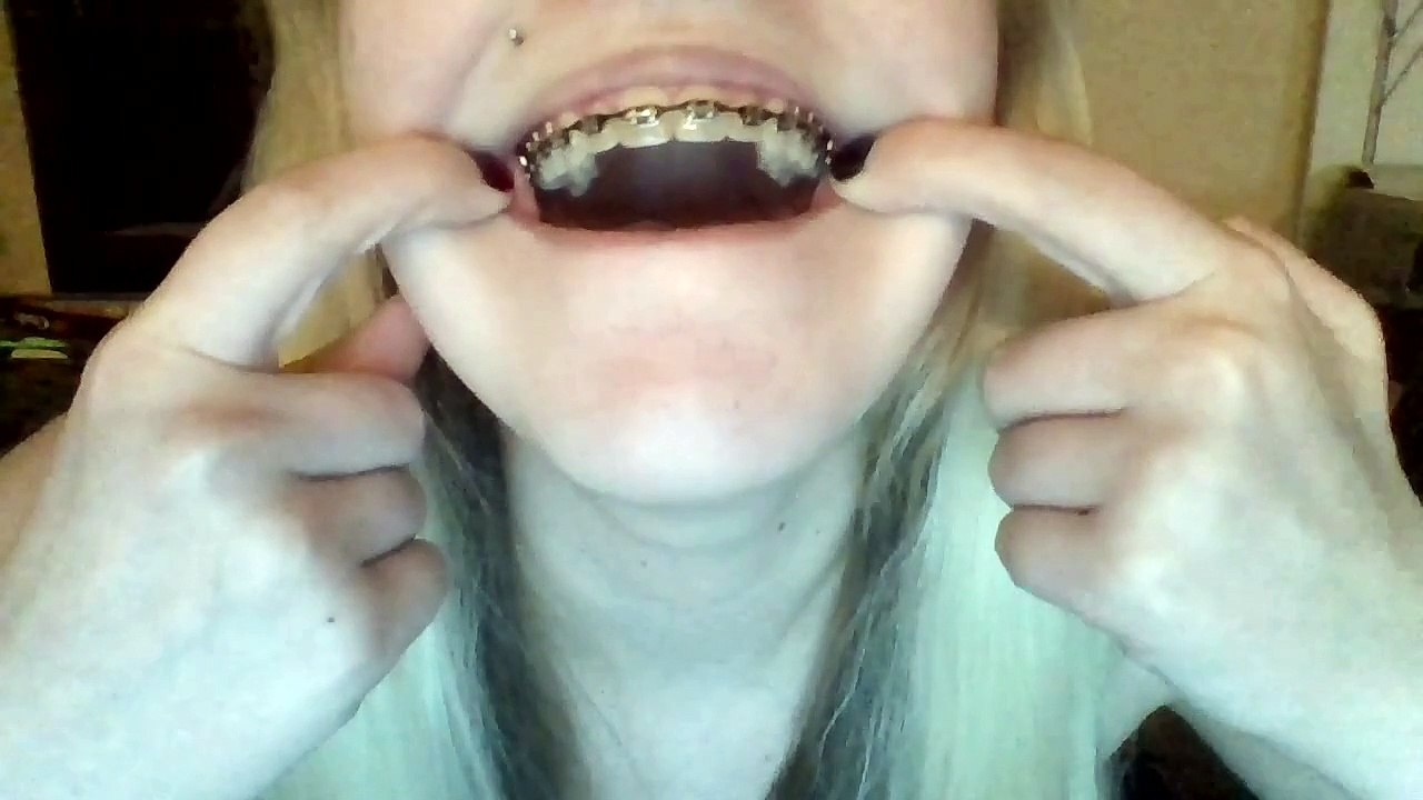 Braces update