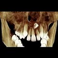 3D X-Ray (Cone-Beam CT)