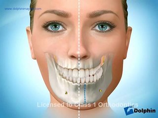 Facial Asymmetry Surgery Mandibular Class 1 Orthodontics