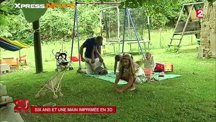 Maxence 6 ans va recevoir une prothèse de main imprimée en 3D