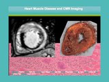 Heart Muscle Disease and Cardiac Magnetic Resonance Imaging - Dr Sam Mohiddin