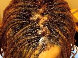 Egypt Lawson-Hairline Illusions Cranial Prosthesis Before and After Hair Loss Alopecia Case Studies