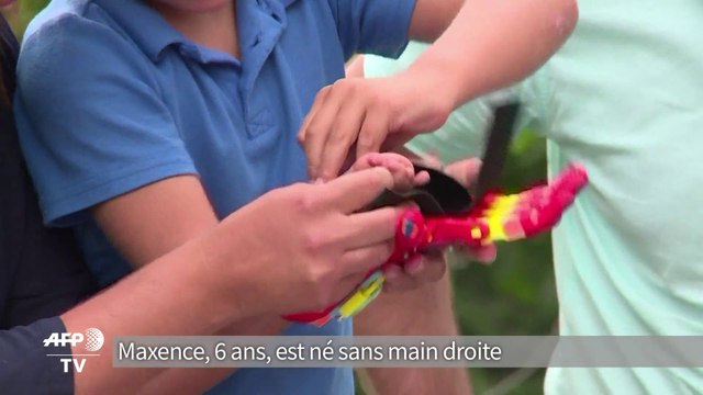 Impression 3D: donner une main aux enfants qui n'en ont pas