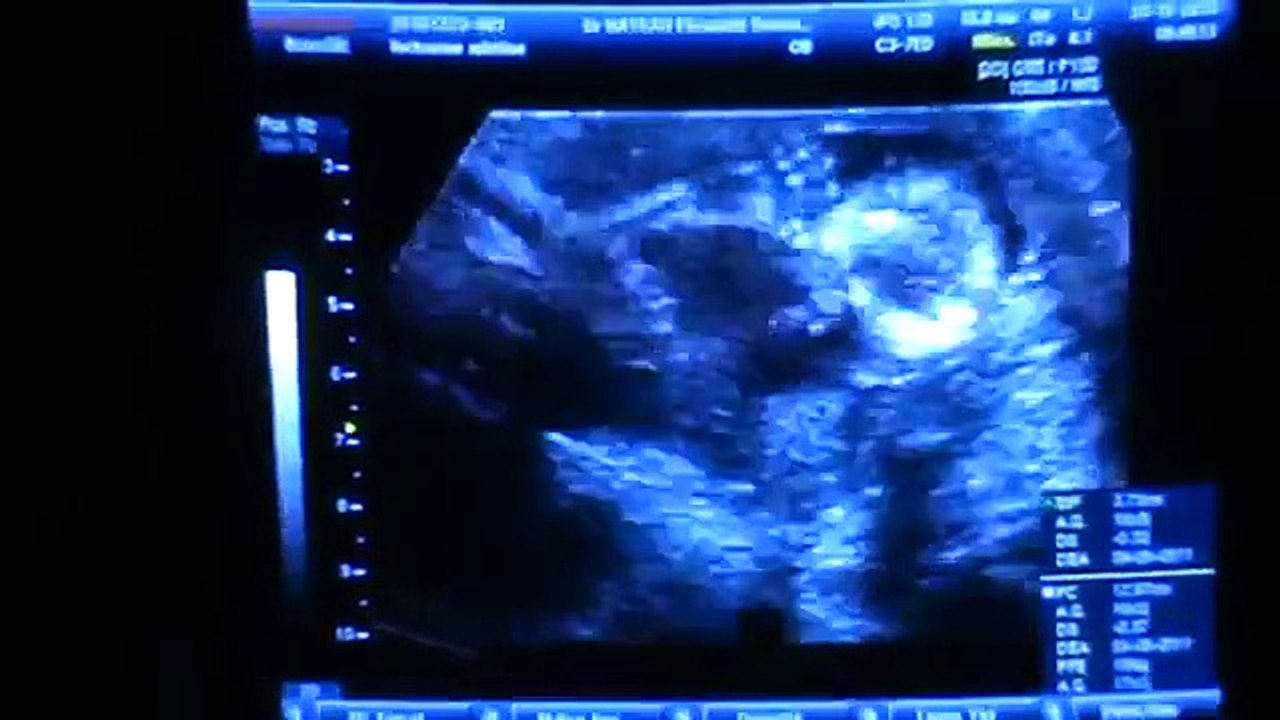 Echographie du foetus à 4 mois