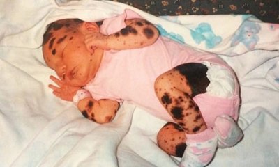 Djevojčica sa nevjerovatnim poremećajem kože