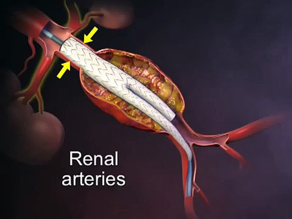 Endovascular Graft in an Abdominal Aortic Aneurysm