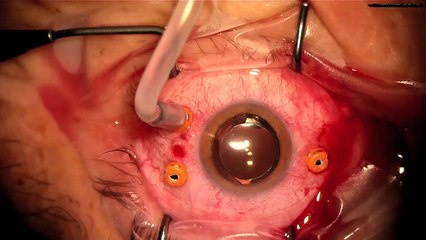 Retinal Detachment When You Can’t Find the Tear Filipe Henriques