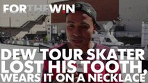 Dew Tour skater lost tooth, now wears it on a necklace