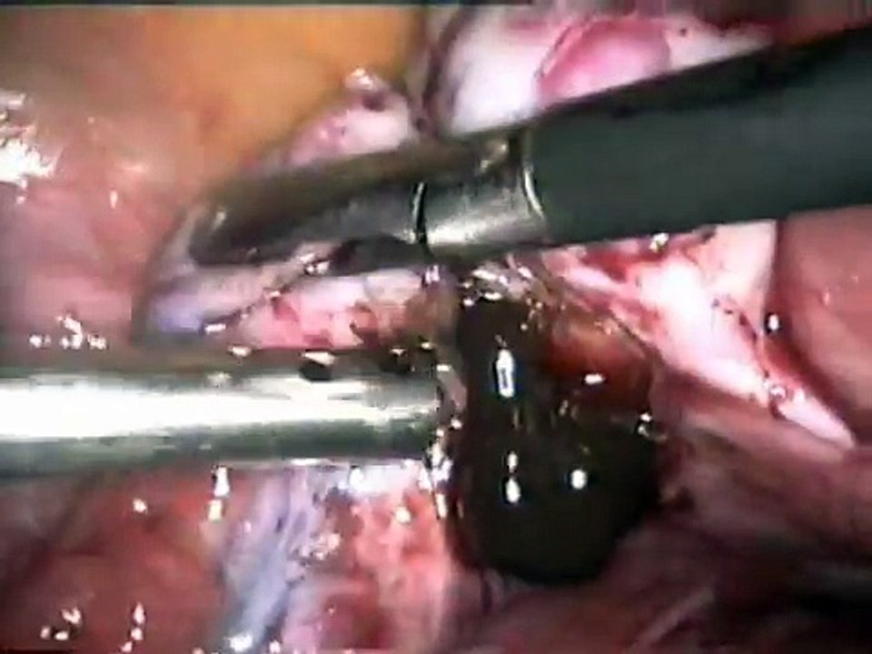 Endometrioma Laparoscopy