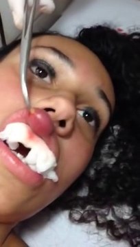 This girl has a Fly larva growing up into her lips!! Growth!!