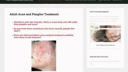 Best Permanent Treatment of Acne at Very Affordable Price