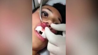 Moment larvae is removed from girl's lip(Video)