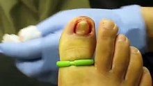 Ingrown Toenail Removal Surgery