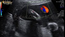 Ecografia Doppler color embarazo de 28 semanas arterias y vena cordon umbilical Dr. Rafael Ortega