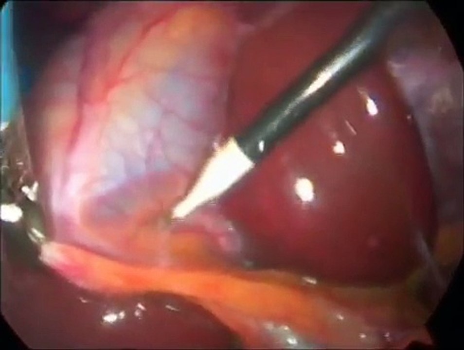 Routine Lap Chole/cholangiogram
