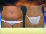 Dr. Sam Shatkin Jr. Body Contouring Lipo and Breast Implants