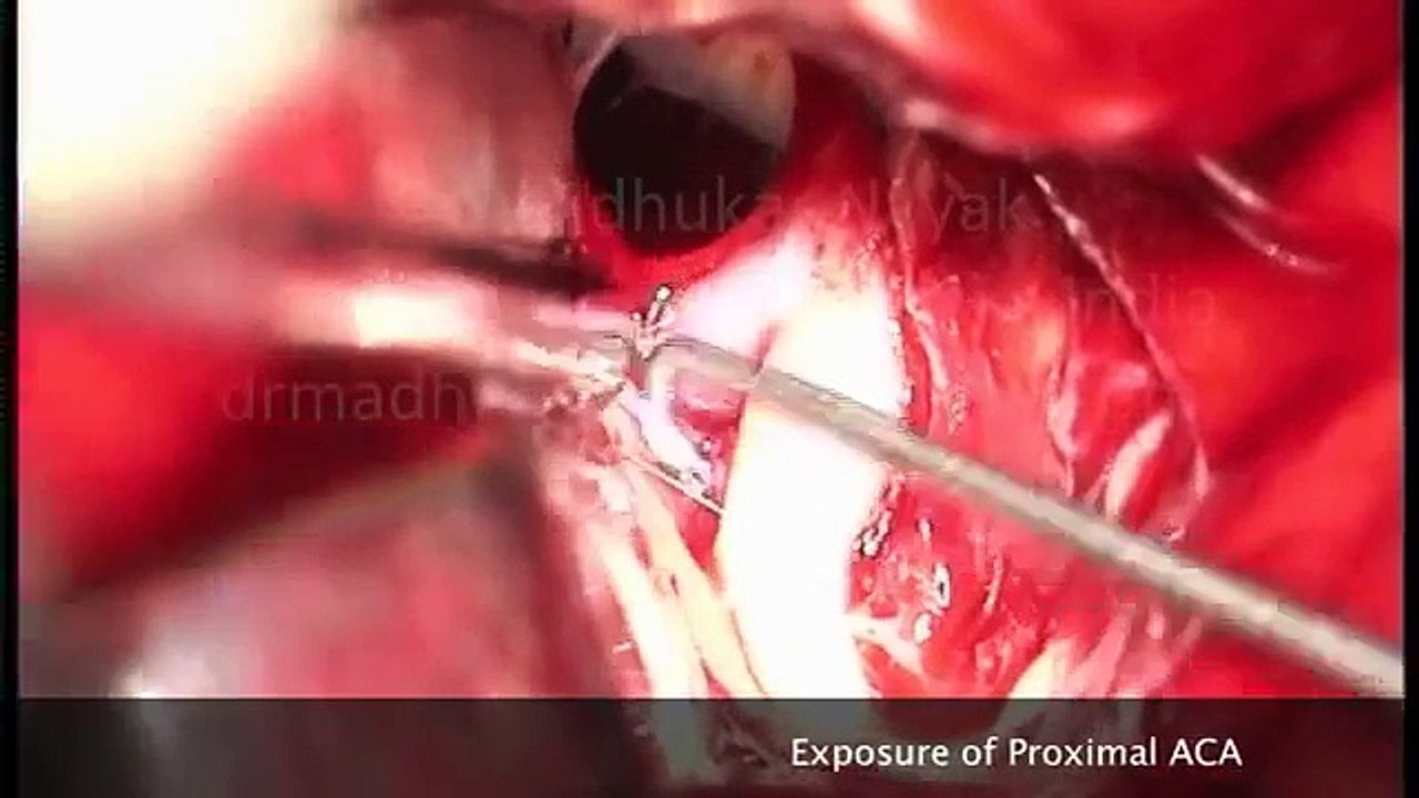 CRANIOTOMY AND CLIPPING OF ACOM ARTERY ANEURYSM