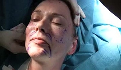 French Lift Treatment at Harley Street Skin Clinic