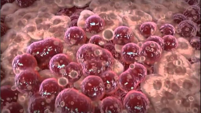 Si po i vret gratë kanceri i mitrës? Çdo javë vdes një nënë, 120 raste të reja në vit