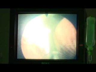 Lajme - Ndërhyrje me rreze lazer në spitalin MIM