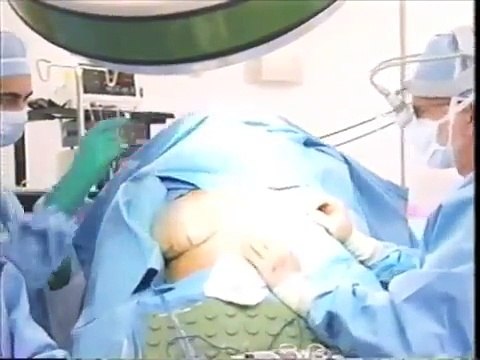 Secondary Breast Revision - replacement w smaller implant by Plastic Surgeon Dr Handel - Joy
