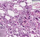 Histopathology Breast --Fat necrosis, traumatic