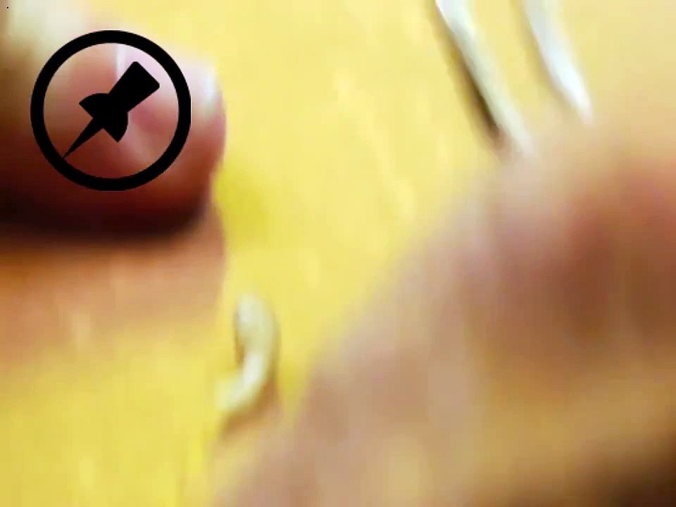 Bot Fly Removal1