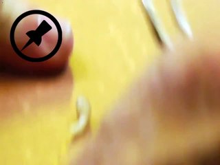 Bot Fly Removal1